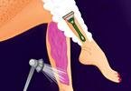 Legs Treatment