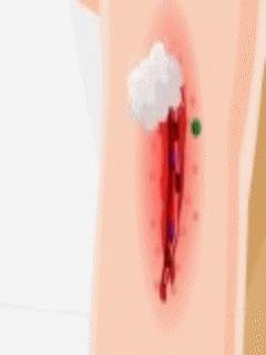 Barbie After Injury